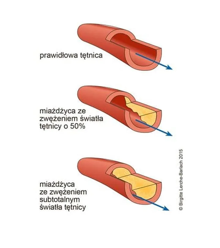 Przyczyny choroby tętnic obwodowych